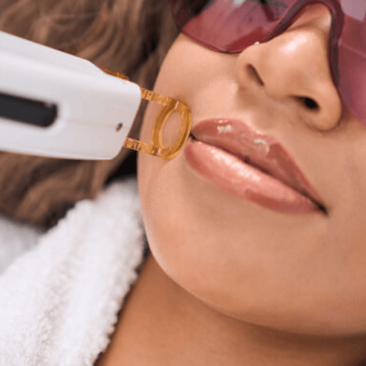Chin Laser Hair Removal (12 Sessions) - HueVine Wellness + Spa